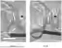 Fig. 08 - IMPROVED CEREBRAL ANGIOGRAPHY CATHETER