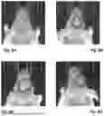 Fig. 09 - SYSTEM AND METHOD FOR LOCALIZED THERAPEUTIC TREATMENT