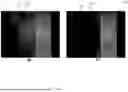 Fig. 10 - SUPPRESSING INTERFERENCE ARTIFACTS IN ULTRASOUND