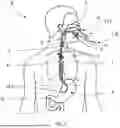 Fig. 02 - SYSTEMS, APPARATUS, AND METHODS FOR PLACING AND/OR CONFIRMING A LOCATION OF AN END OF A NASOGASTRIC OR AN OROGASTRIC TUBE
