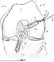 Fig. 02 - INTERFERENCE SCREWS