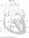 Fig. 02 - PROSTHETIC HEART VALVE THAT REDUCES NATIVE ANNULUS