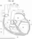 Fig. 03 - PROSTHETIC HEART VALVE THAT REDUCES NATIVE ANNULUS