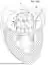 Fig. 07 - PROSTHETIC HEART VALVE THAT REDUCES NATIVE ANNULUS