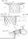 Fig. 14 - PROSTHETIC HEART VALVE THAT REDUCES NATIVE ANNULUS