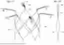 Fig. 34 - PROSTHETIC HEART VALVE THAT REDUCES NATIVE ANNULUS