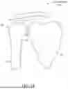 Fig. 02 - Humeral Reconstruction System and Methods of Use