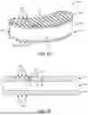 Fig. 07 - INTEGRAL GRAFT INTERBODY DEVICES