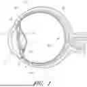 Fig. 02 - DRUG ELUTING OCULAR IMPLANTS