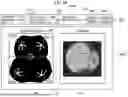 Fig. 18 - SYSTEMS AND METHODS FOR COMBINING FUNDUS IMAGES OF AN EYE