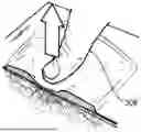 Fig. 01 - PROPHYLACTIC DRESSING