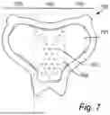 Fig. 08 - PROPHYLACTIC DRESSING