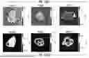 Fig. 15 - LEFT ATRIUM SHAPE RECONSTRUCTION FROM SPARSE LOCATION MEASUREMENTS USING NEURAL NETWORKS