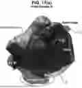 Fig. 28 - LEFT ATRIUM SHAPE RECONSTRUCTION FROM SPARSE LOCATION MEASUREMENTS USING NEURAL NETWORKS