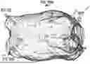 Fig. 32 - LEFT ATRIUM SHAPE RECONSTRUCTION FROM SPARSE LOCATION MEASUREMENTS USING NEURAL NETWORKS