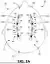 Fig. 06 - LEAD CONFIGURED TO DETECT STROKE METRICS