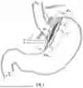 Fig. 02 - ENDOSCOPE CONVERSION KIT
