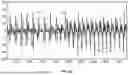 Fig. 14 - METHOD AND SYSTEMS FOR HEART CONDITION DETECTION USING AN ACCELEROMETER