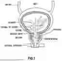 Fig. 02 - UROLOGICAL CHITOSAN STENT AND DELIVERY SYSTEM
