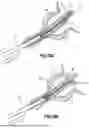 Fig. 07 - UROLOGICAL CHITOSAN STENT AND DELIVERY SYSTEM