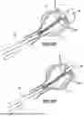 Fig. 09 - UROLOGICAL CHITOSAN STENT AND DELIVERY SYSTEM
