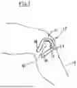 Fig. 02 - DEVICES AND METHODS TO MITIGATE PATELLA MALPOSITIONING