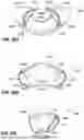Fig. 65 - PATIENT INTERFACE WITH A SEAL-FORMING STRUCTURE HAVING VARYING THICKNESS