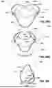 Fig. 68 - PATIENT INTERFACE WITH A SEAL-FORMING STRUCTURE HAVING VARYING THICKNESS