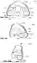 Fig. 76 - PATIENT INTERFACE WITH A SEAL-FORMING STRUCTURE HAVING VARYING THICKNESS