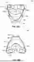 Fig. 78 - PATIENT INTERFACE WITH A SEAL-FORMING STRUCTURE HAVING VARYING THICKNESS