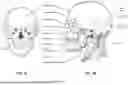Fig. 12 - CONDUIT HEADGEAR CONNECTOR FOR PATIENT INTERFACE