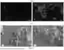 Fig. 02 - TUMOR MICROBIOME ANALYSIS AS A PROGNOSTIC INDICATOR OF PROSTATE CANCER