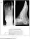 Fig. 06 - SYSTEM AND METHOD FOR CLASSIFYING TYPE OF A FRACTURE ON MUSCULOSKELETAL X-RAY IMAGE