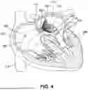 Fig. 05 - TRANSCATHETER VALVE RECAPTURE DEVICES AND METHODS