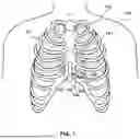 Fig. 02 - IMPLANTABLE ELECTRICAL LEADS AND ASSOCIATED DELIVERY SYSTEMS