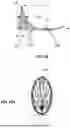 Fig. 40 - Method of Treating a Blood Vessel with Multiple Shock Wave Discharge Points in a Catheter Balloon