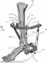 Fig. 01 - External Fixation for the Correction of Bone Deformity and Trauma