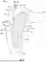 Fig. 03 - JOINT REPLACEMENT SYSTEM ENABLING JOINT MOVEMENT
