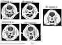 Fig. 09 - COMPOSITIONS COMPRISING STING AGONISTS AND METHODS OF USE FOR TREATING GLIOMA