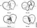 Fig. 07 - Sutureless Anastomosis Device and Uses Thereof