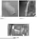 Fig. 02 - Nerve Wrap Using Constructed Tissue
