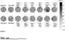 Fig. 02 - METHOD OF TREATMENT AND SELECTION OF PATIENTS BENEFITING FROM AGOMELATINE BASED ON EEG MEASUREMENTS