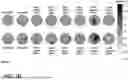 Fig. 03 - METHOD OF TREATMENT AND SELECTION OF PATIENTS BENEFITING FROM AGOMELATINE BASED ON EEG MEASUREMENTS