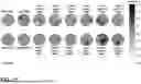 Fig. 04 - METHOD OF TREATMENT AND SELECTION OF PATIENTS BENEFITING FROM AGOMELATINE BASED ON EEG MEASUREMENTS