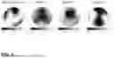Fig. 10 - METHOD OF TREATMENT AND SELECTION OF PATIENTS BENEFITING FROM AGOMELATINE BASED ON EEG MEASUREMENTS