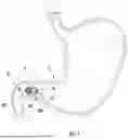 Fig. 02 - DEVICES, SYSTEMS, AND METHODS FOR OCCLUDING AN ANATOMICAL PASSAGE