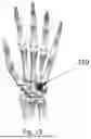 Fig. 18 - GOLF GLOVE WITH ADJUSTABLE SWING AND HAND POSITION TRAINER