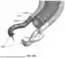 Fig. 22 - EXTERNAL WORKING CHANNELS FOR ENDOSCOPIC DEVICES