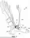 Fig. 08 - ANTERIOR ANKLE APPROACH SYSTEM AND METHOD