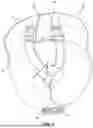 Fig. 03 - Shoulder Support for Lateral Decubitus Positioning